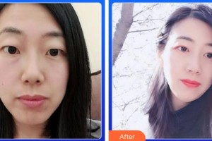 資陽(yáng)市中醫(yī)醫(yī)院眼科黃緒清整形價(jià)格表附切開雙眼皮案例展示