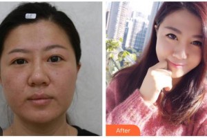 資陽(yáng)市中醫(yī)醫(yī)院眼科張永整形價(jià)格表附埋線雙眼皮案例展示