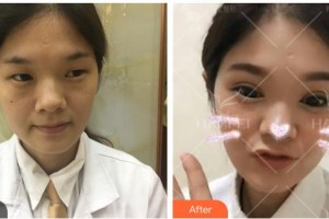 資陽(yáng)市中醫(yī)醫(yī)院眼科秦慶整形價(jià)格表附切開雙眼皮案例展示