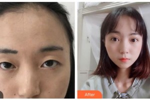 資陽(yáng)市中醫(yī)醫(yī)院眼科宋良智整形價(jià)格表附切開雙眼皮案例展示