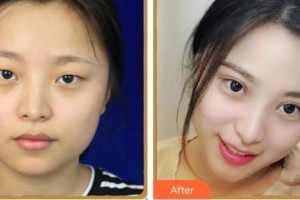 涼山愛爾眼科醫(yī)院周鵬整形價(jià)格表附眼部綜合案例展示