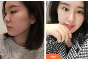 涼山愛爾眼科醫(yī)院蘇茜整形價(jià)格表附眼部綜合案例展示