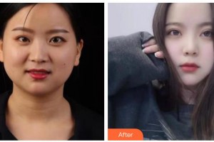 涼山愛爾眼科醫(yī)院李國良整形價格表附眼部綜合案例展示