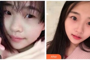 涼山州中西醫(yī)結(jié)合醫(yī)院眼科陳浩整形價格表附切開雙眼皮案例展示