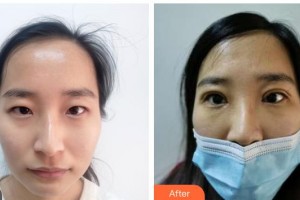 武警湖南總隊(duì)醫(yī)院整形美容中心包校偉整形價格表附眼部綜合案例展示