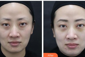 武警湖南總隊(duì)醫(yī)院整形美容中心夏紅梅整形價格表附激光去眼袋案例展示