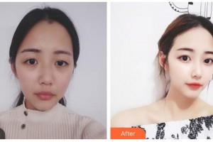 武警湖南總隊(duì)醫(yī)院整形美容中心高衛(wèi)先整形價格表附埋線提升案例展示