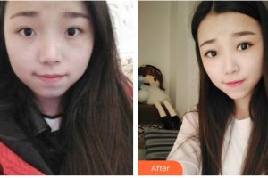 湖南省中醫(yī)藥研究院附屬醫(yī)院醫(yī)學(xué)美容中心何高洲整形價格表附切開雙眼皮案例展示