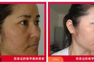 湖南省中醫(yī)藥研究院附屬醫(yī)院醫(yī)學(xué)美容中心謝會平整形價格表附微針美膚案例展示