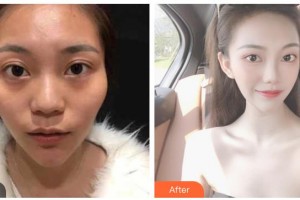 湖南省中醫(yī)藥研究院附屬醫(yī)院醫(yī)學(xué)美容中心黃寧申整形價格表附熱瑪吉案例展示