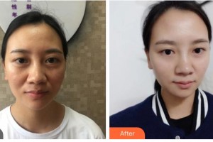 湖南省南華大學(xué)附一醫(yī)院激光美容中心譚善彰 整形價格表附埋線提升案例展示