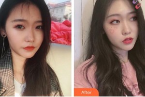 湖南省南華大學(xué)附一醫(yī)院激光美容中心陳碾 整形價格表附激光除皺案例展示