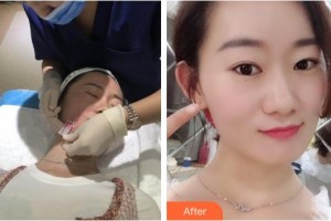 湖南中醫(yī)藥大學(xué)第一附屬醫(yī)院整形美容中心劉芳整形價格表附埋線提升案例展示