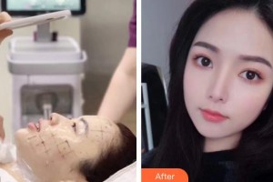 湖南中醫(yī)藥大學(xué)第一附屬醫(yī)院整形美容中心辛衛(wèi)平整形價格表附熱瑪吉案例展示