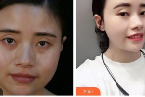 湖南省人民醫(yī)院整形激光美容中心歐陽華偉整形價格表附埋線提升案例展示