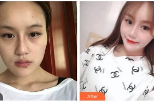 湖南省人民醫(yī)院整形激光美容中心丁衛(wèi)住院醫(yī)師整形價格表附埋線提升案例展示