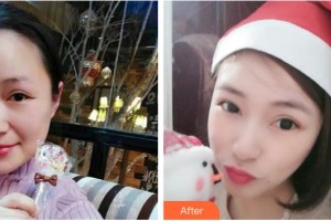 湖南省第二人民醫(yī)院整形美容中心肖調(diào)立整形價格表附埋線提升案例展示