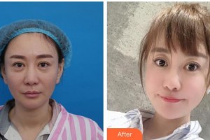 湖南省第二人民醫(yī)院整形美容中心宋金榮整形價格表附埋線提升案例展示