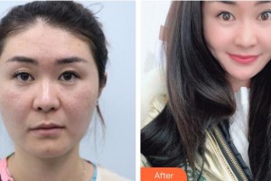 武警湖南總隊(duì)醫(yī)院整形美容中心吳忠好整形價(jià)格表附埋線提升案例展示