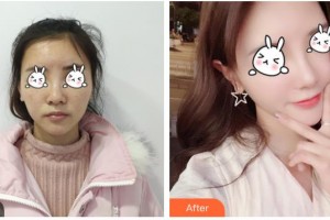 湖南省第二人民醫(yī)院整形美容中心王榮基整形價(jià)格表附光子嫩膚案例展示