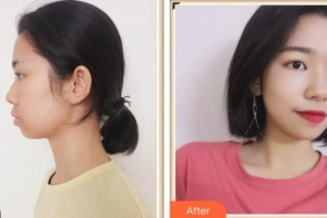 湖南省第二人民醫(yī)院整形美容中心呂霞整形價(jià)格表附清潔祛痘案例展示