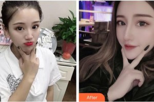 湖南美研醫(yī)療美容門診部張彬整形價(jià)格表附鼻部綜合案例展示