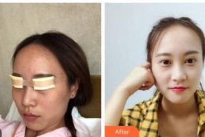 湖南博雅眼科醫(yī)院王成業(yè)整形價格表附切開雙眼皮案例展示