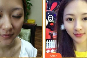 湖南博雅眼科醫(yī)院羅知衛(wèi)整形價(jià)格表附眼部綜合案例展示