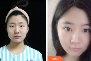 湖南博雅眼科醫(yī)院袁苑整形價(jià)格表附切開雙眼皮案例展示
