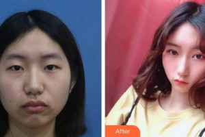 湖南博雅眼科醫(yī)院李曦整形價(jià)格表附上瞼提肌案例展示