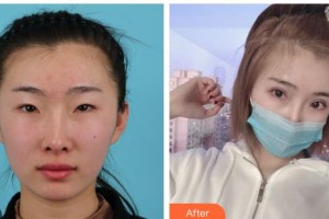 湖南博雅眼科醫(yī)院劉三元整形價(jià)格表附眼部綜合案例展示