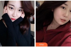 湖南博雅眼科醫(yī)院劉素平整形價(jià)格表附切開雙眼皮案例展示