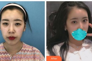 湖南博雅眼科醫(yī)院林影芳整形價(jià)格表附眼部綜合案例展示