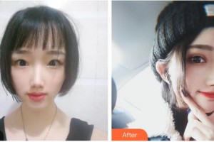 湖南博雅眼科醫(yī)院胡蓉整形價(jià)格表附切開雙眼皮案例展示