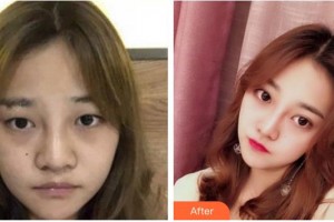 湖南博雅眼科醫(yī)院段智博整形價(jià)格表附切開雙眼皮案例展示