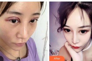 湖南省直中醫(yī)醫(yī)院眼科代敏整形價(jià)格表附切開雙眼皮案例展示
