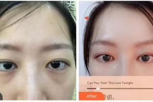 湖南省直中醫(yī)醫(yī)院眼科肖哲夫整形價(jià)格表附內(nèi)切祛眼袋案例展示