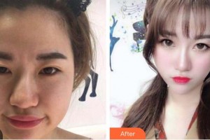 株洲中雅醫(yī)療美容門診部文學(xué)海整形價(jià)格表附埋線提升案例展示