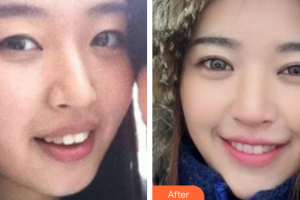 深圳口腔診所溫家強整形價格表附牙齒隱形矯正案例展示