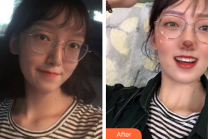 深圳博愛曙光醫(yī)院高蘇健整形價格表附金屬托槽矯正案例展示