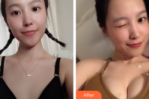 珠海微創(chuàng)外科醫(yī)院李長江整形價格表附自體脂肪隆胸案例展示