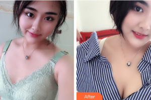 珠海陸達(dá)美容外科醫(yī)院陳越文整形價格表附自體脂肪隆胸案例展示