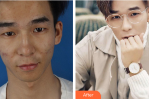 珠海陸達(dá)美容外科醫(yī)院曾超整形價格表附微針祛痘煥膚案例展示