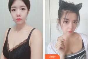 珠海陸達(dá)美容外科醫(yī)院侯大慶整形價格表附自體脂肪隆胸案例展示