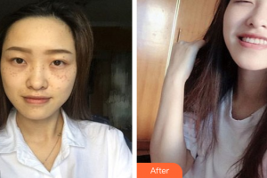 珠海陸達(dá)美容外科醫(yī)院王愛平整形價格表附激光美膚祛斑案例展示