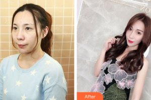 珠海陸達(dá)美容外科醫(yī)院韓淑英整形價格表附鼻部綜合案例展示