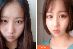 珠海陽光醫(yī)院整形美容中心朱曉東整形價格表附肋軟骨隆鼻案例展示