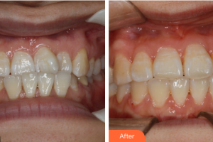 珠海陸達(dá)美容外科醫(yī)院李镕整形價格表附直絲弓矯正案例展示