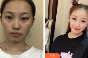 珠海六和醫(yī)院醫(yī)學(xué)美容科周玲玲整形價格表附光子嫩膚案例展示