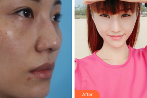 珠海方華醫(yī)院醫(yī)學(xué)美容科方明整形價格表附激光祛斑案例展示